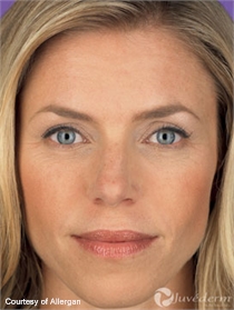Juvederm before and after image.