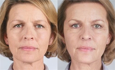 Sculptra before and after