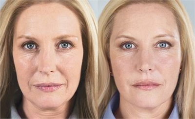 Sculptra before and after