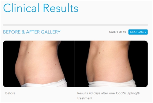 CoolSculpting Results Gallery