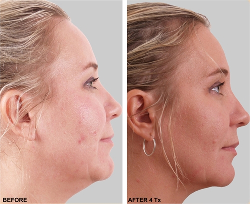 Exilis Before and After Lower Face