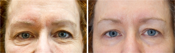 Exilis Before and After Face