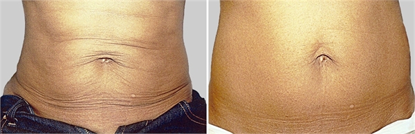 Exilis Before and After Stomach