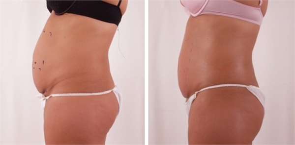 Exilis Before and After Stomach